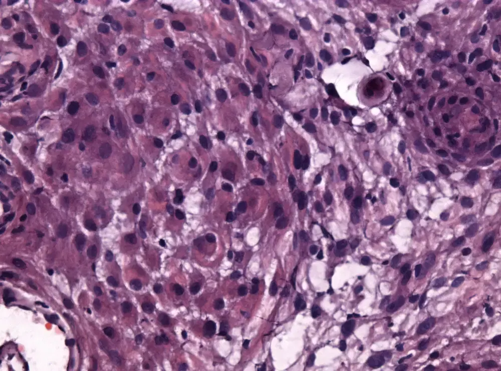 Microfotografía de una muestra histológica de meningioma rabdoide